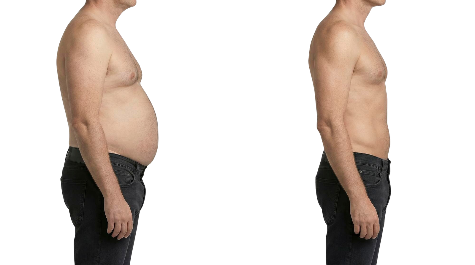 La liposuccion ciblée en Turquie avant après
