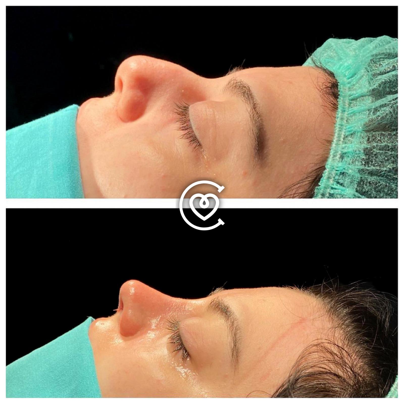 Photo avant-après de rhinoplastie