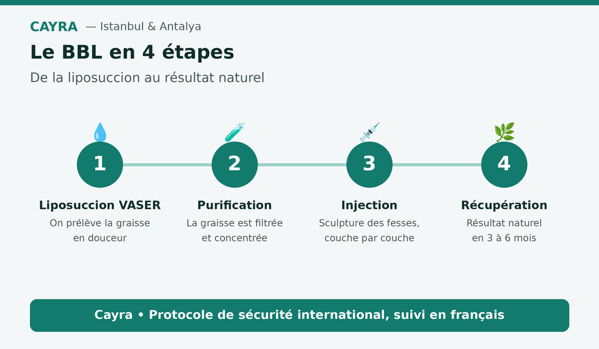 Le BBL en 4 étapes : liposuccion VASER, purification, injection et récupération — Cayra.