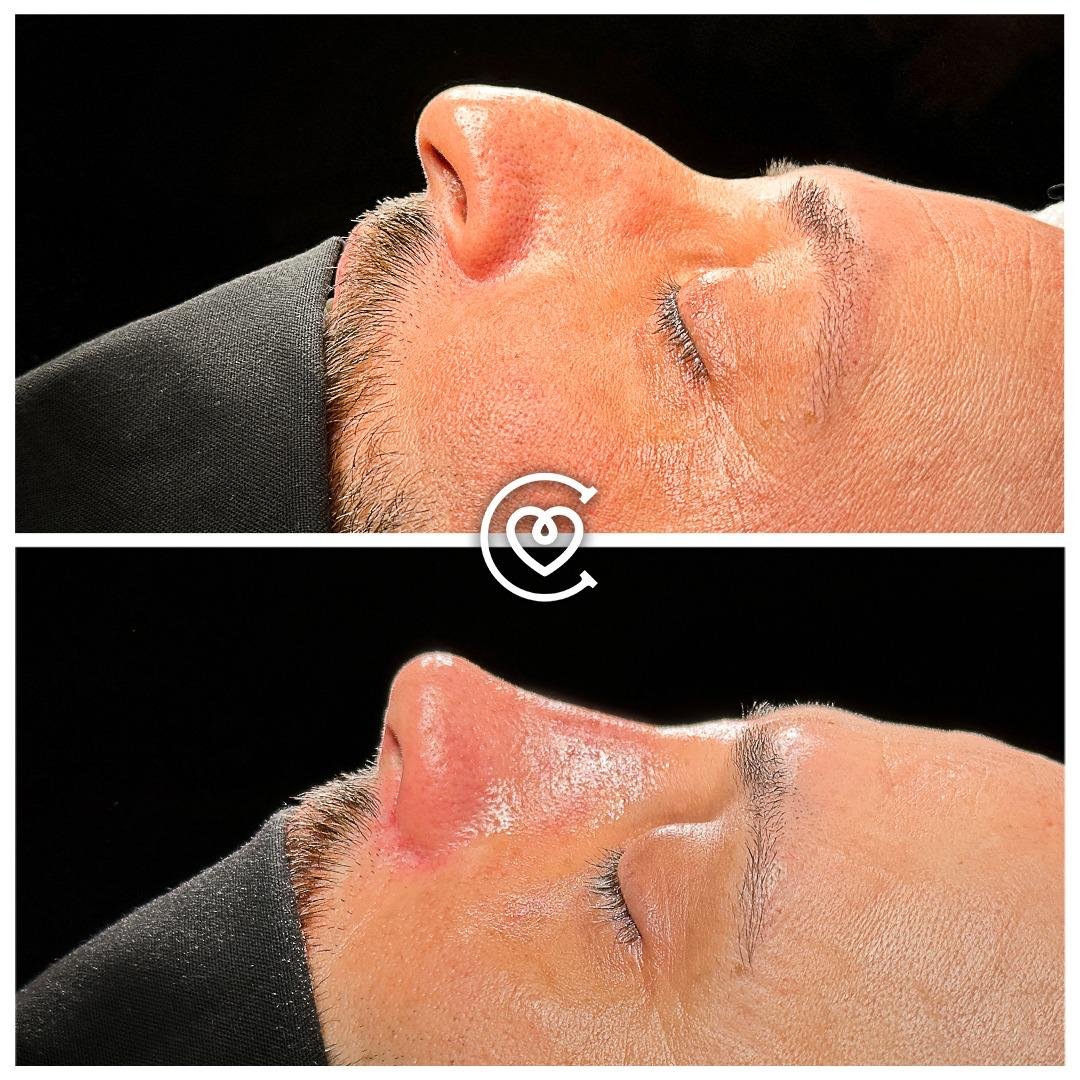 chirurgie du nez homme