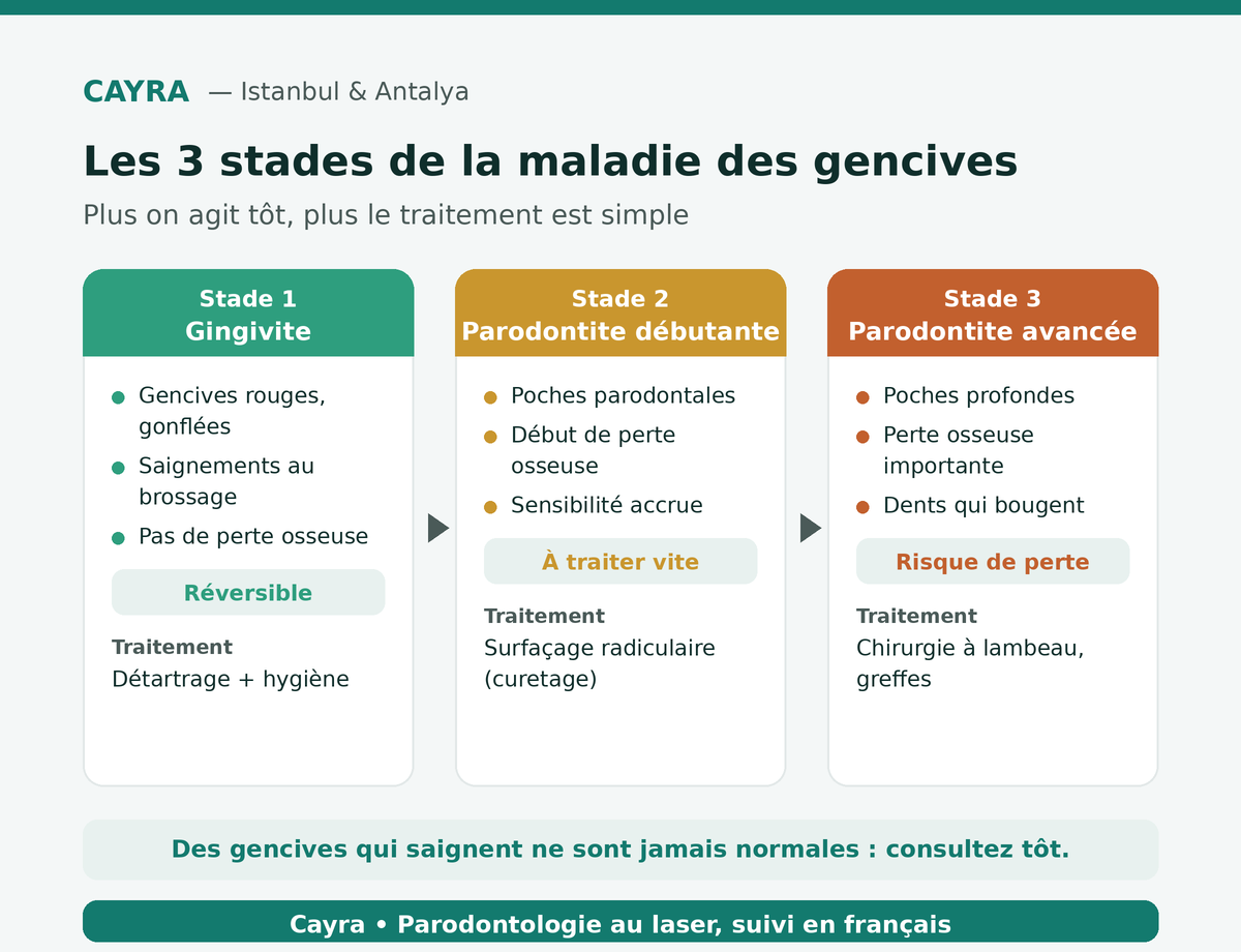 les 3 stades de la maladie des gencives : gingivite, parodontite débutante et avancée — Cayra