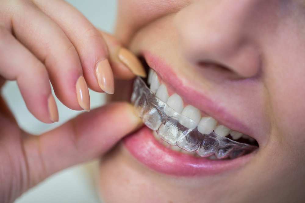 orthodontie en Turquie