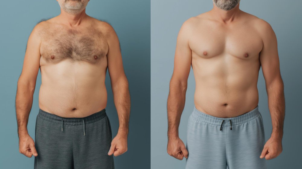 réduction mammaire homme