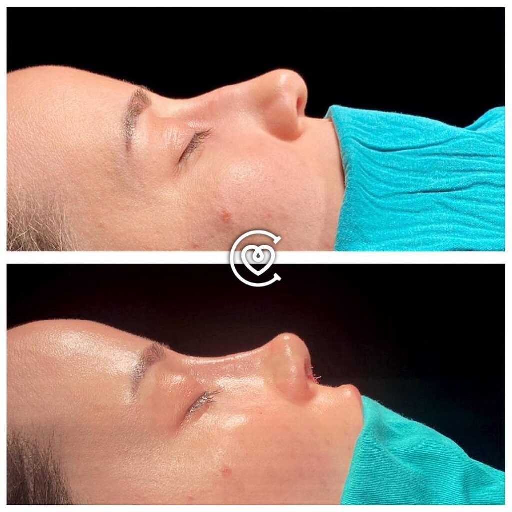 rhinoplastie en Turquie un nez naturel et harmonieux — Cayra