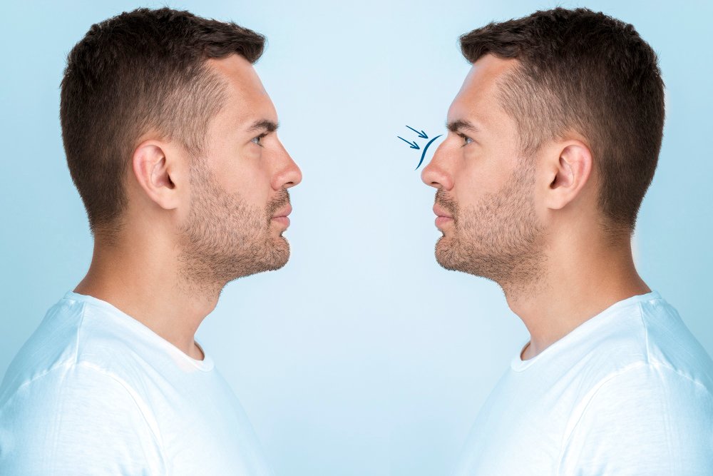 rhinoplastie masculine en Turquie