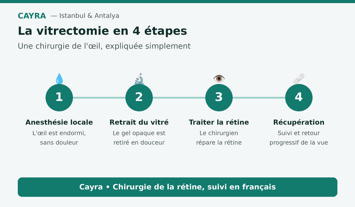 vitrectomie en Turquie : le déroulement en 4 étapes — Cayra
