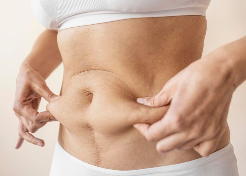 Abdominoplastie complète pour retendre la peau du ventre et resserrer les muscles
