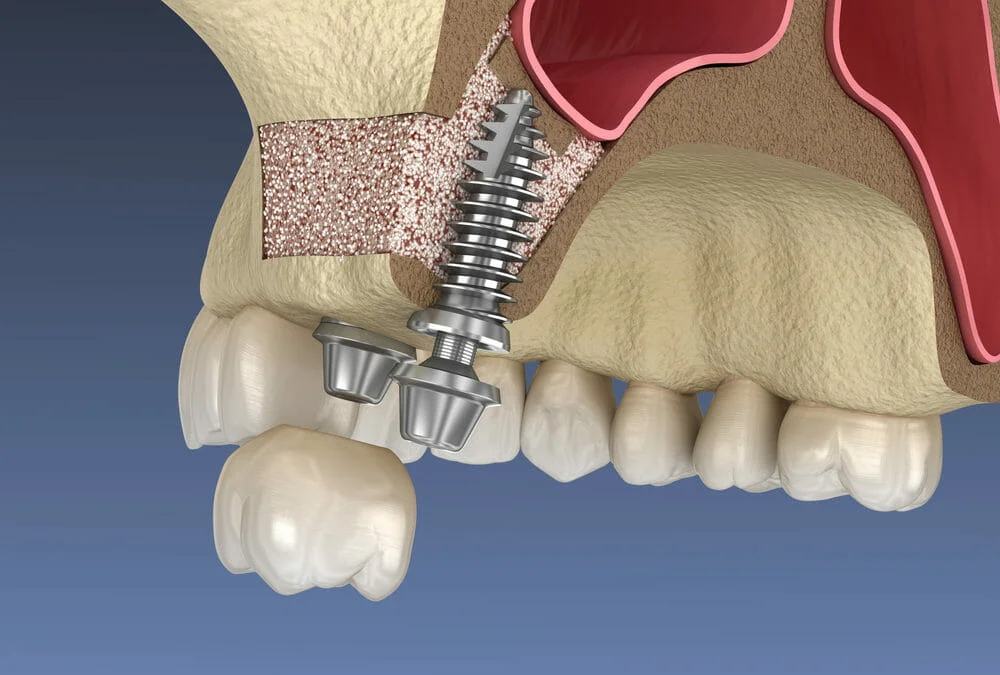 Traitement orthodontique moderne et aligneurs dentaires invisibles