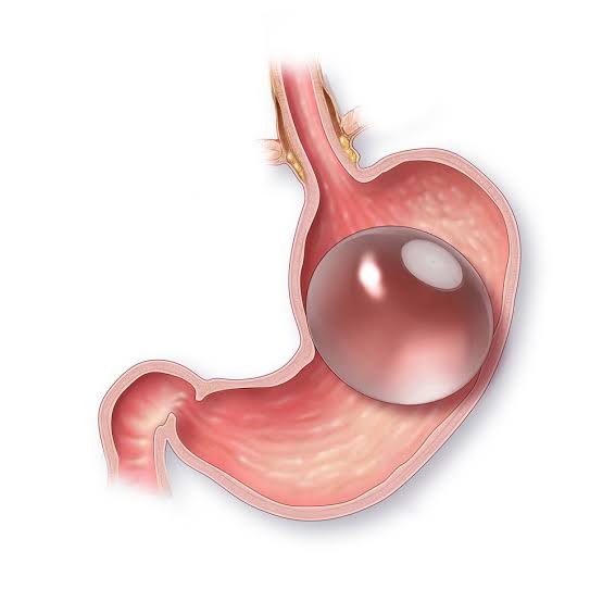 Pose de ballon gastrique elipse sans anesthésie ni chirurgie chez Cayra Clinic