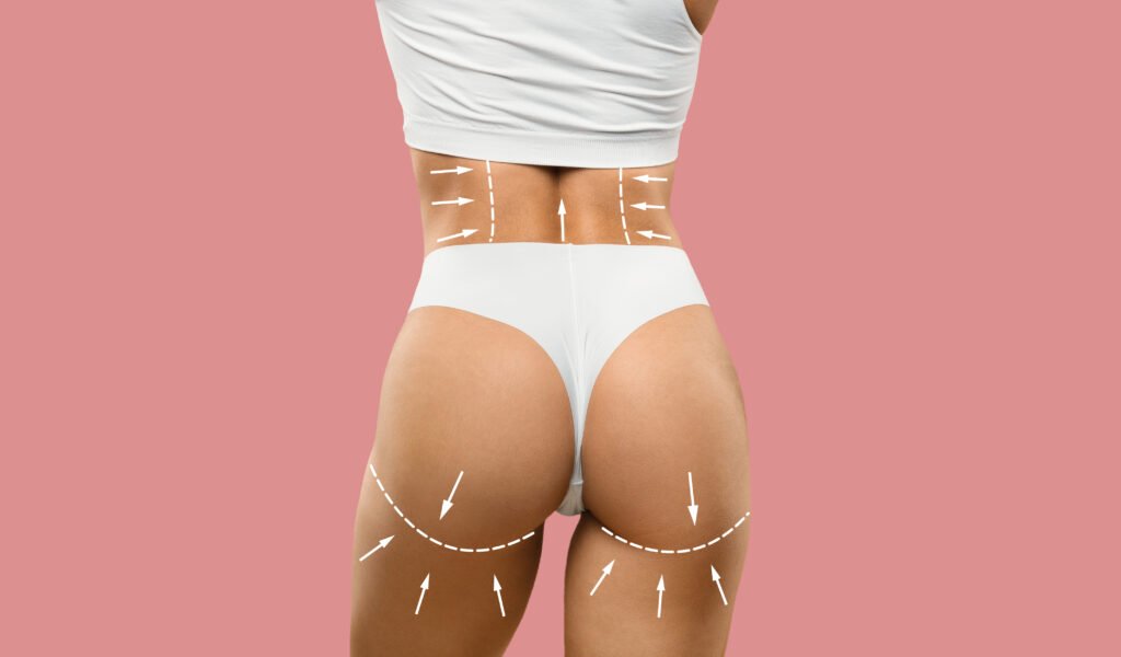 Augmentation fessière hybride combinant implants et transfert de graisse