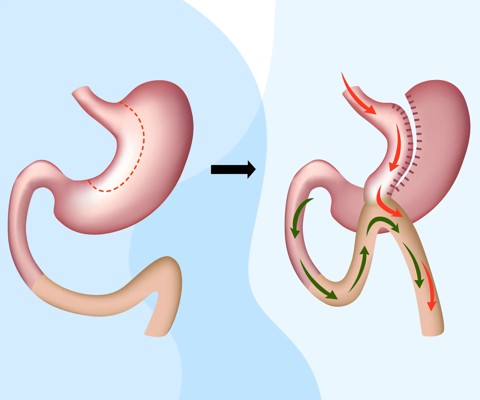 Bypass gastrique classique en Y pour réduire l absorption des calories