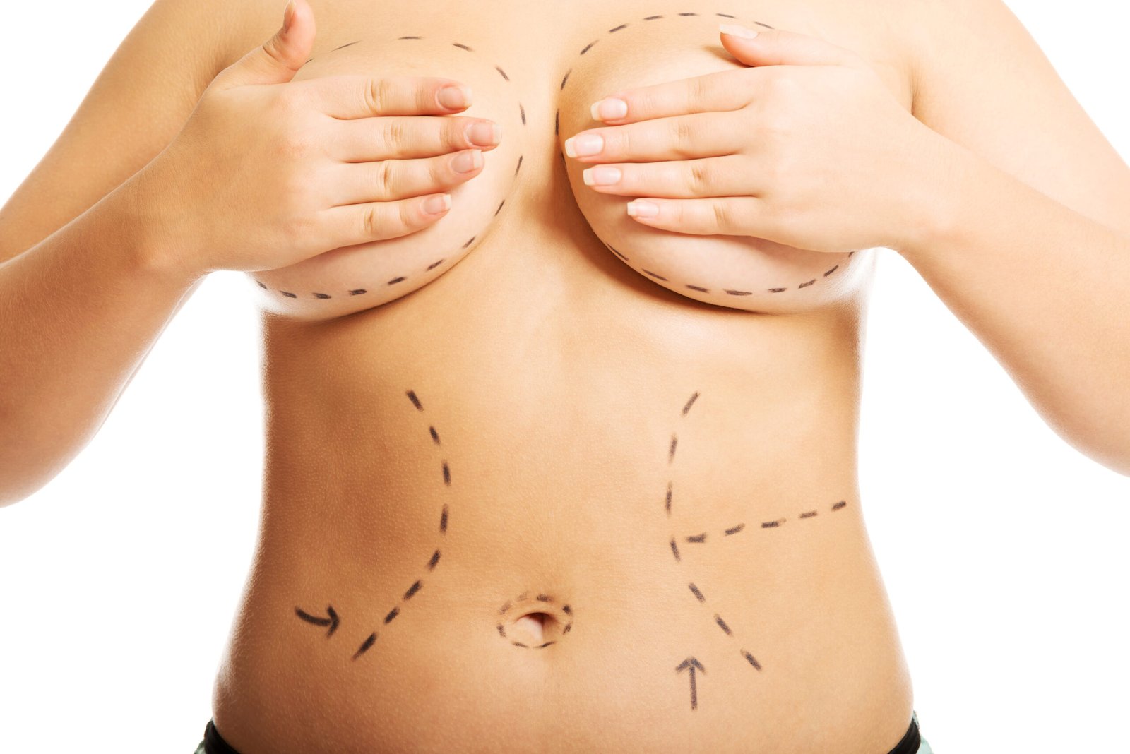 Chirurgie combinée abdominoplastie et lifting mammaire Mommy Makeover chez Cayra Clinic