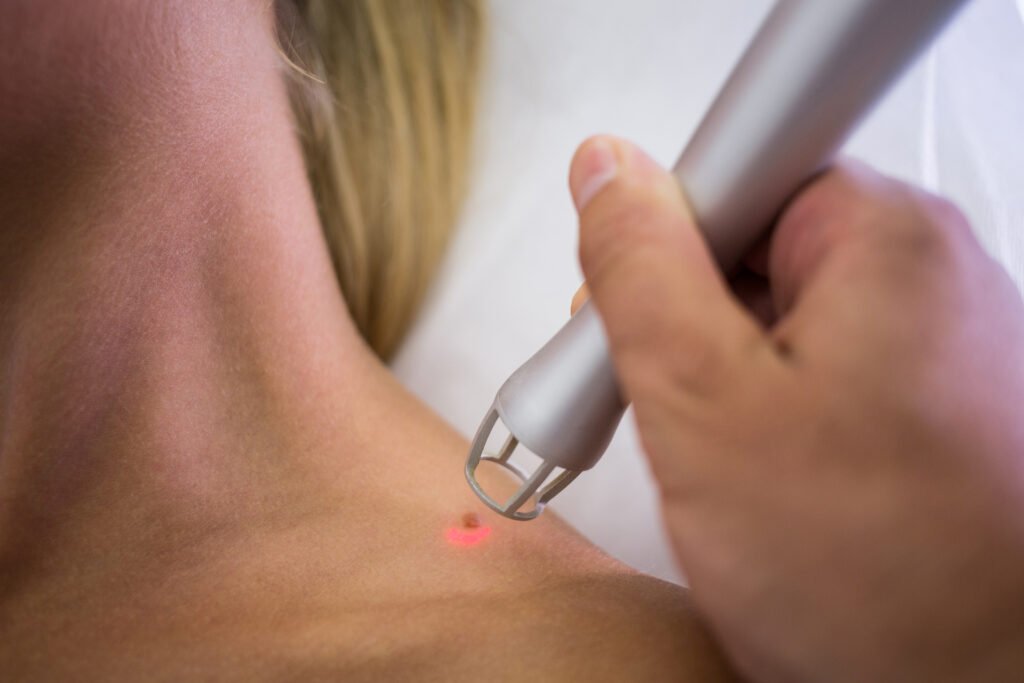 Consultation de dermatologie pour exérèse de lipome et kyste à la Cayra Clinic