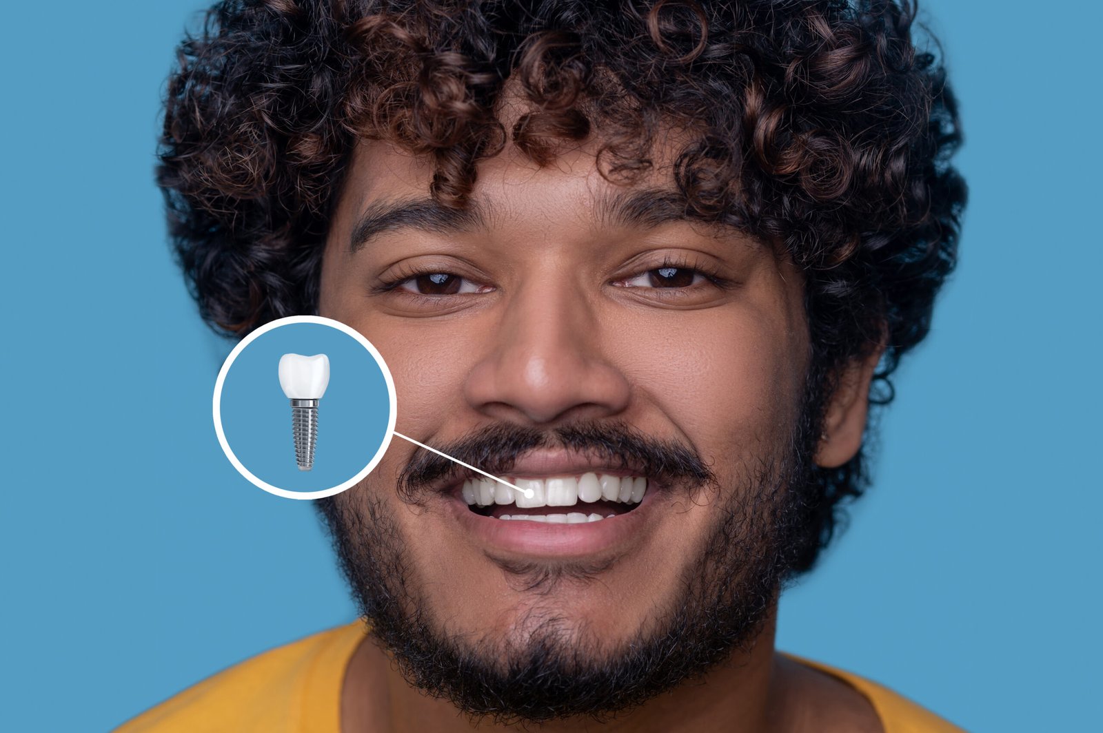 Facettes dentaires en porcelaine et E-Max pour un sourire parfait à Istanbul