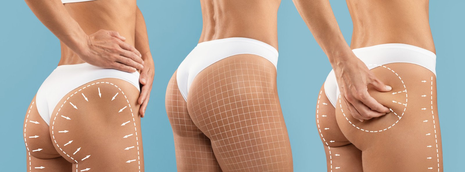 Gaine de contention post-opératoire pour stabiliser le galbe des fesses