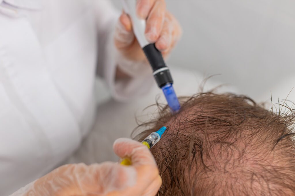 Synergie entre greffe de cheveux FUE et injections d exosomes à Istanbul