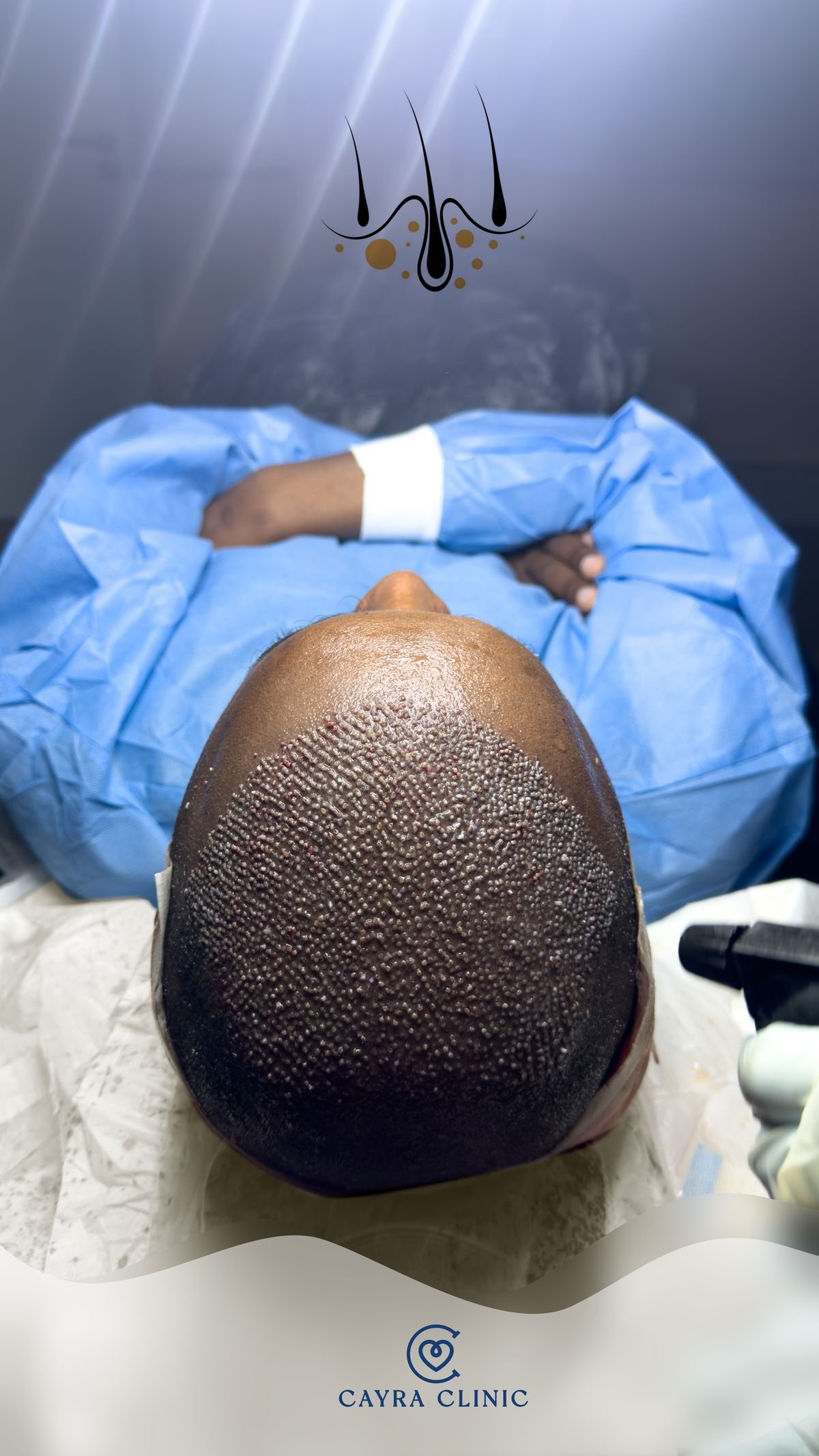 Ouverture des canaux avec lame de saphir pour greffe de cheveux FUE chez Cayra Clinic