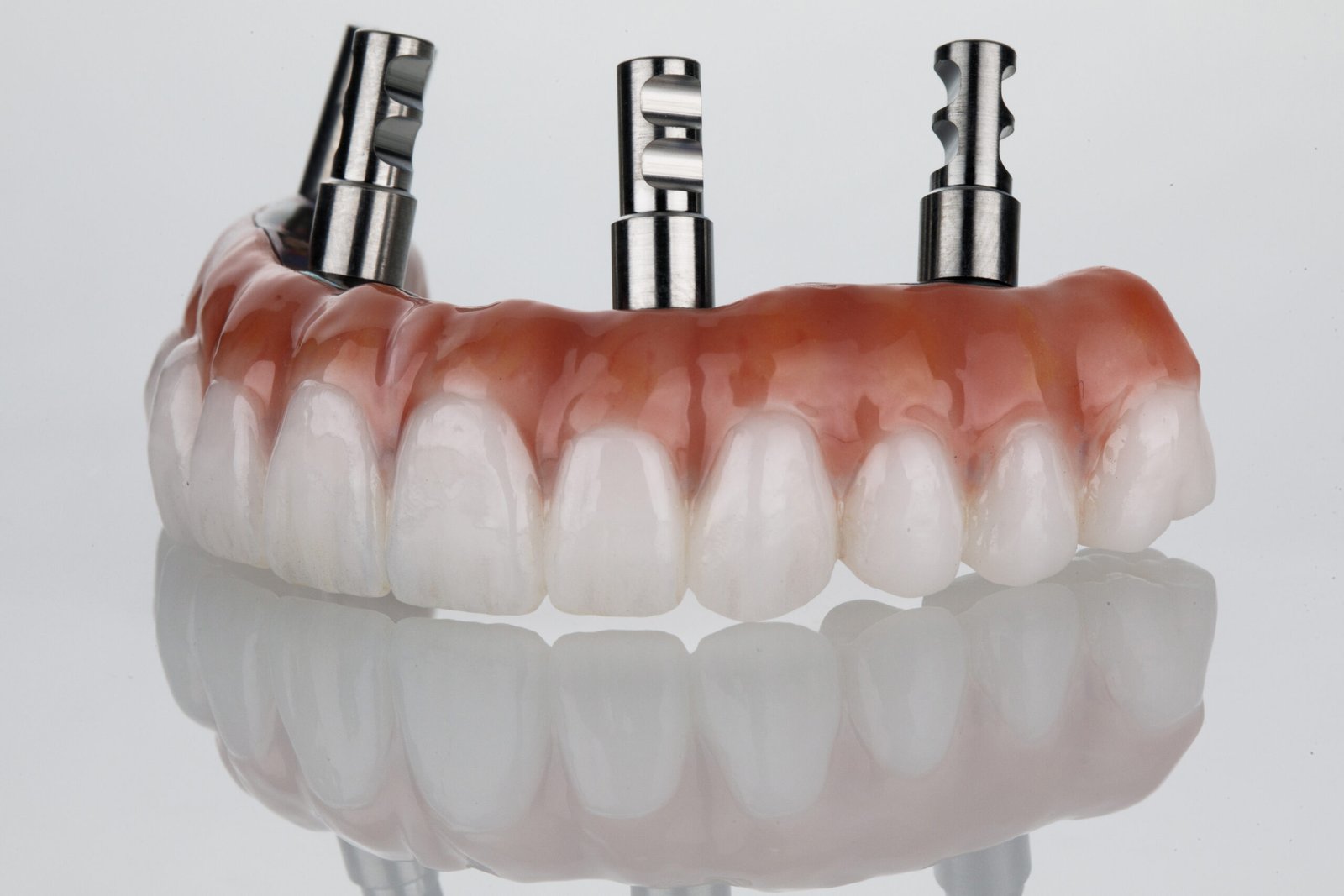 Restauration complète de la mâchoire avec le système d implants All-on-4