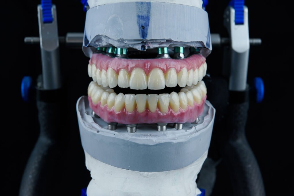 Restauration dentaire complete sur 6 implants All on 6 à Istanbul