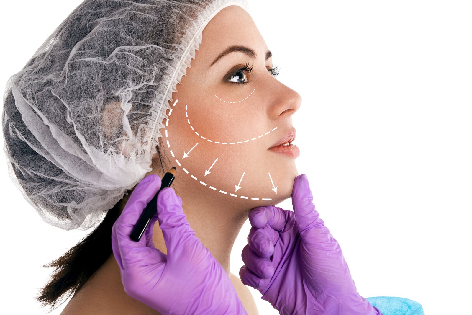 Lip Lift subnasal pour raccourcir l espace entre le nez et la lèvre supérieure