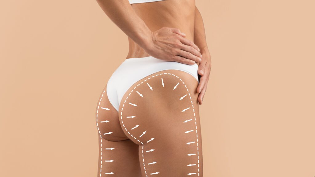 Lower Body Lift pour remonter les fesses et retendre la sangle abdominale