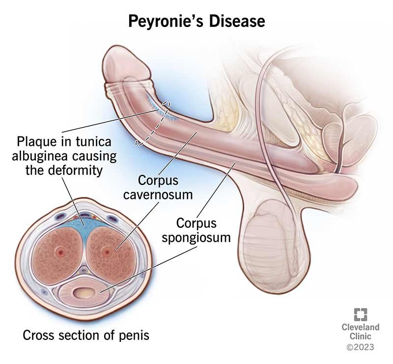 maladie de La Peyronie : consultation urologique confidentielle en Turquie — Cayra