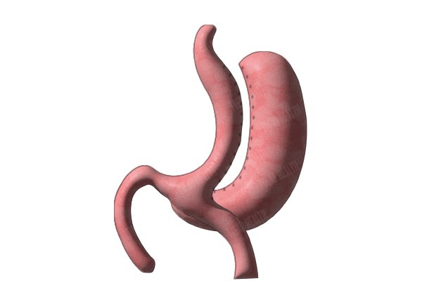 Intervention de mini bypass gastrique efficace contre l obésité sévère à Antalya