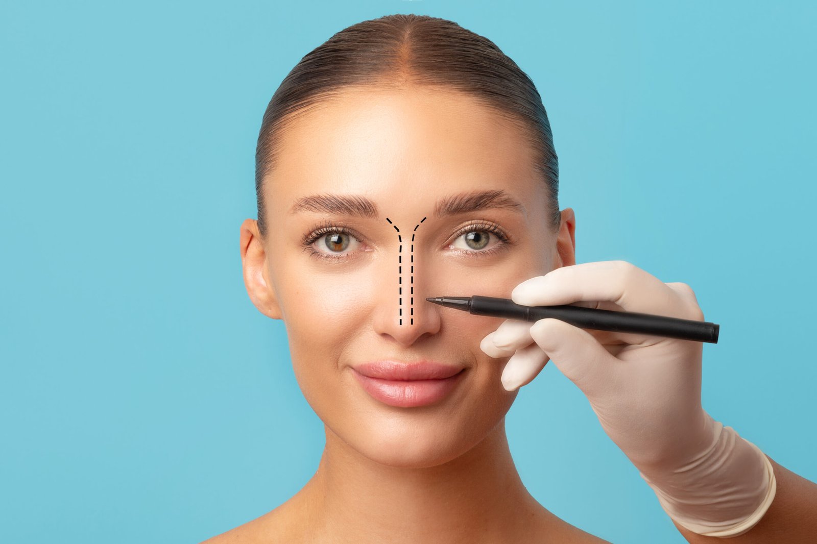 Correction d une rhinoplastie de revision et reconstruction nasale chez Cayra Clinic