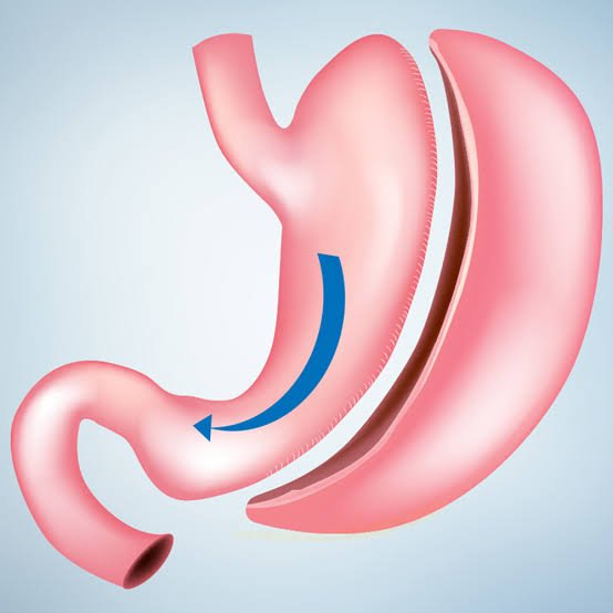Chirurgie de la sleeve gastrique par coelioscopie pour perte de poids à Istanbul