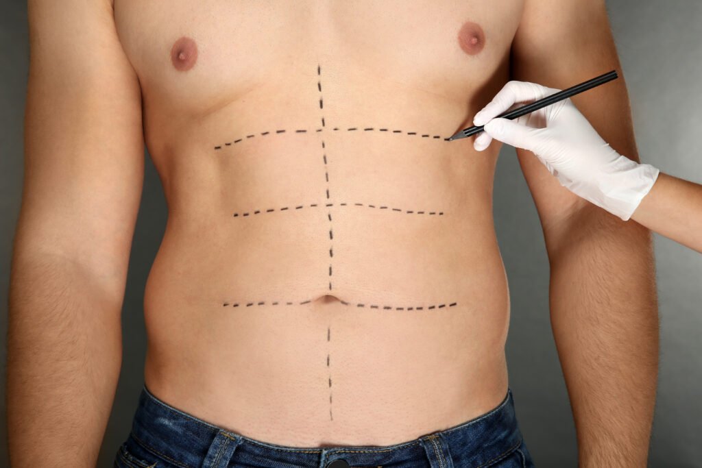 Utilisation de la technologie VASER Lipo pour liposuccion haute definition homme à Istanbul