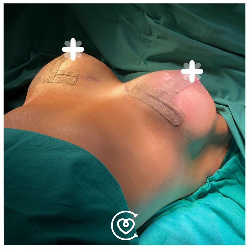 Chirurgie de la gynécomastie pour hommes chez Cayra Clinic à Istanbul