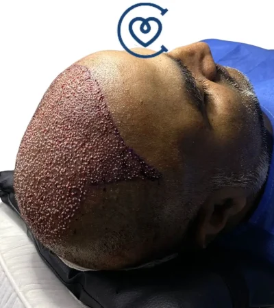 Greffe de cheveux FUE Saphir