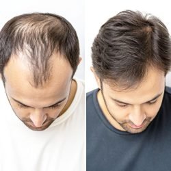 Greffes de cheveux
